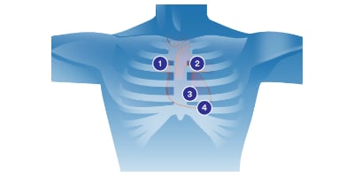 diagram srdeční ascultace
